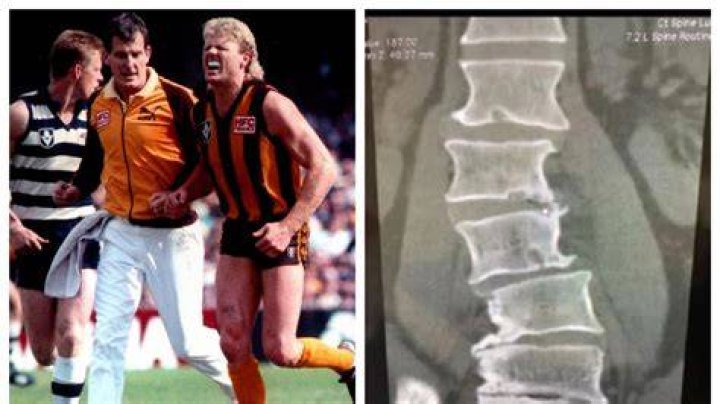 AFL 2020 Hawthorn great Dermott Brereton surgery, xray; news, updates