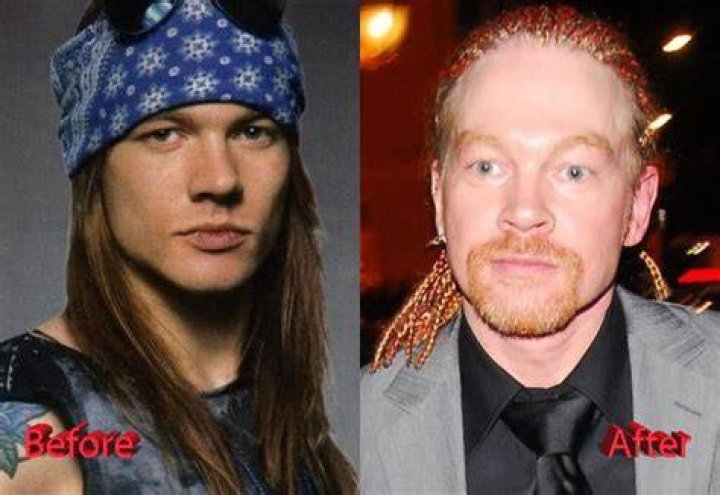 Axl Rose Plastic Surgery A Bad Decision