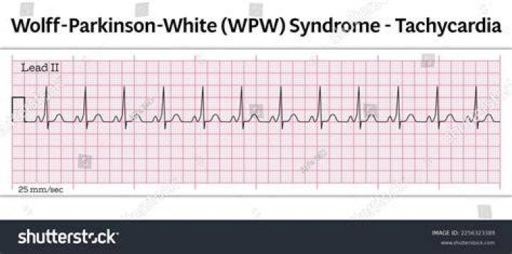 B27. Wolff Parkinson White (WPW) Syndrome Type B