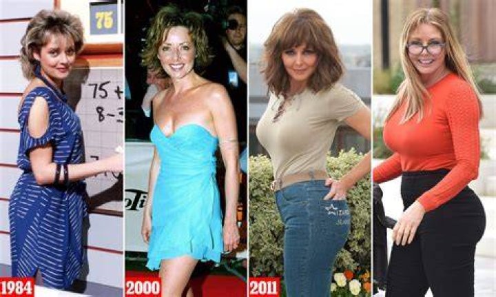 Carol Vorderman Plastic Surgery Journey, True or False?