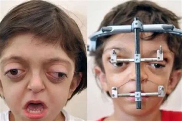 Com s&iacute;ndrome rara, adolescente passa por mais de 70 cirurgias "Sou