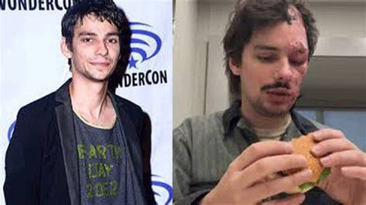 Devon Bostick Accident Led To Face Burn Injury Update