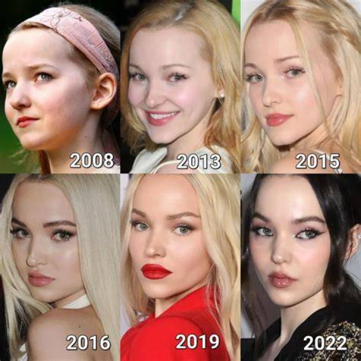 Dove Cameron Plastic Surgery A Few Suspicious Changes