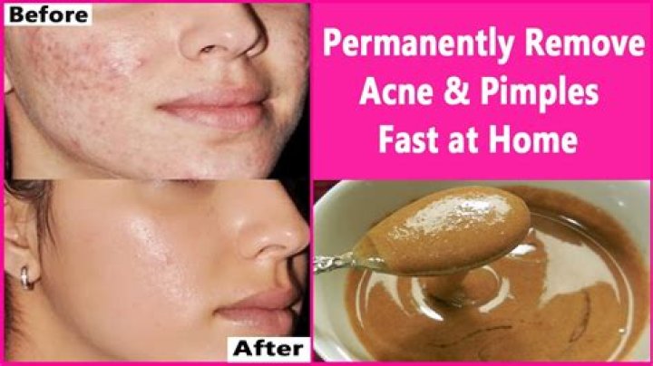 How to Remove Pimples Fast Best Home Remedies for Pimples Remove