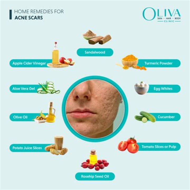 How to remove pimples naturally and permanently at home? Legit.ng