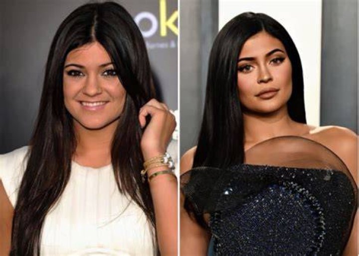 Kylie Jenner Before and after Nose Job, Lip Injections, Breast
