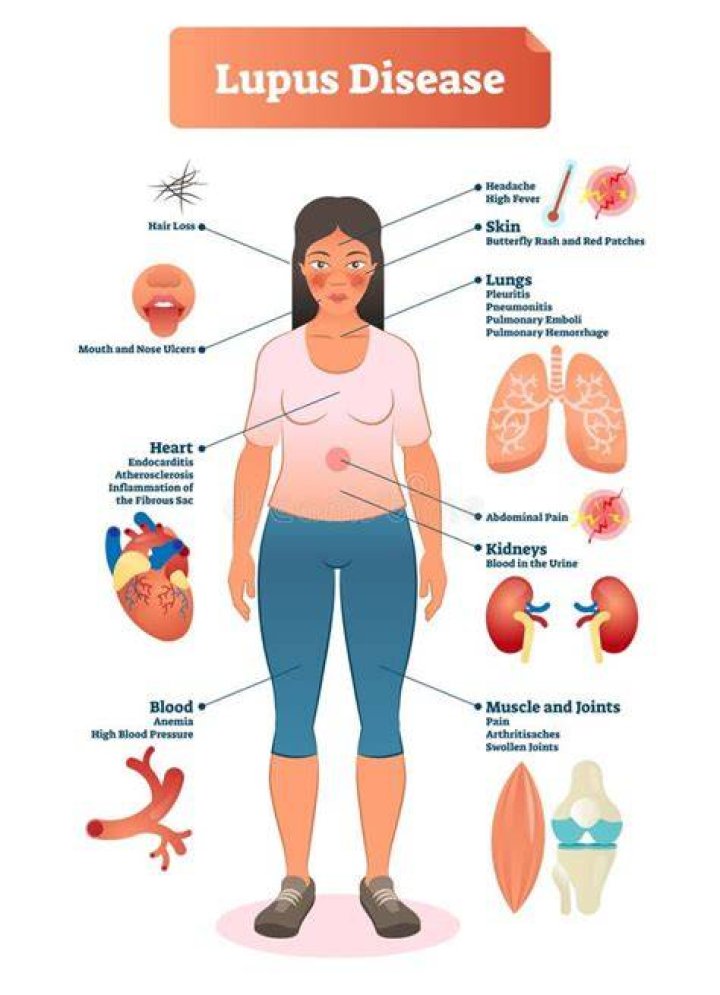 Lupus Diagram
