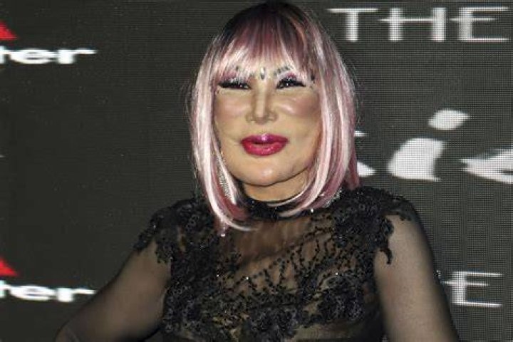 Lyn May's Plastic Surgery Destroyed Her Face What Exactly Went Wrong?