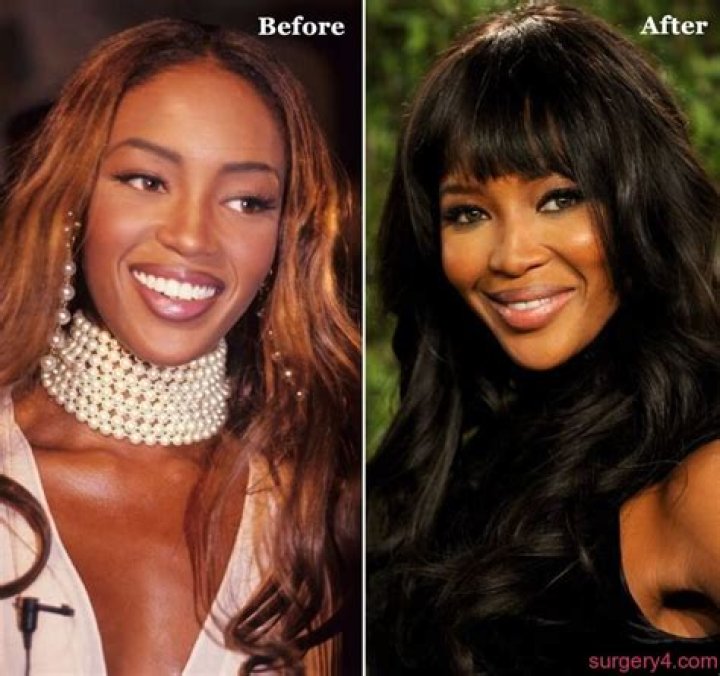 Naomi Campbell Nose Job Before And After Rhinoplasty Photos 2018