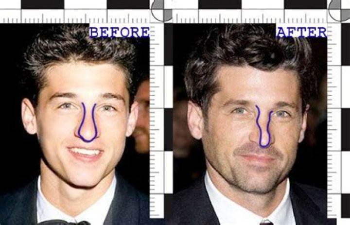 Patrick Dempsey’s Noticeable Nose Job Rawnsley Plastic Surgery