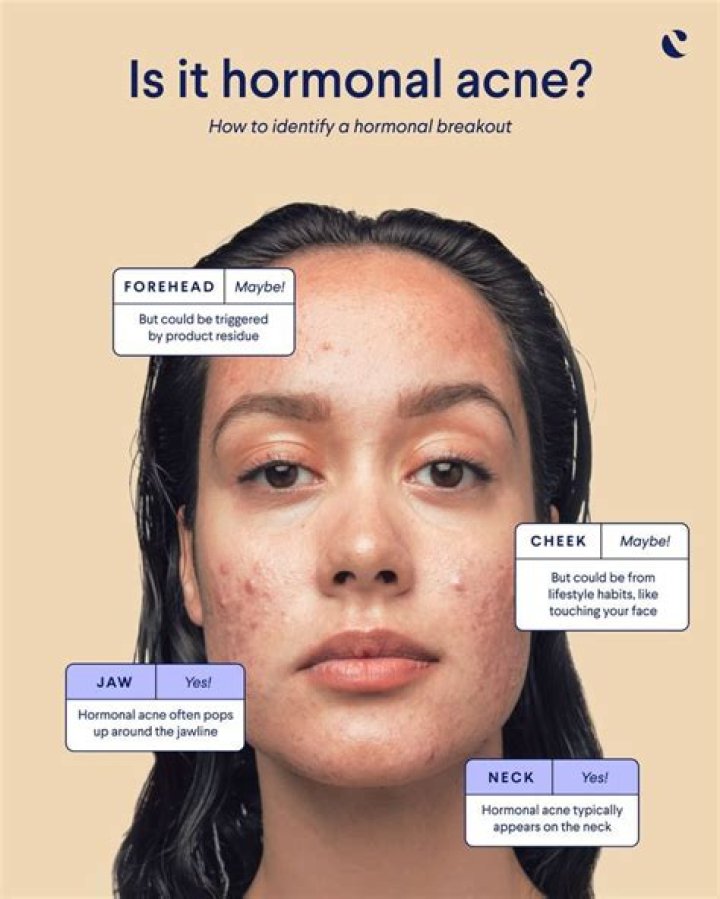 Pin on Hormonal Acne On Chin