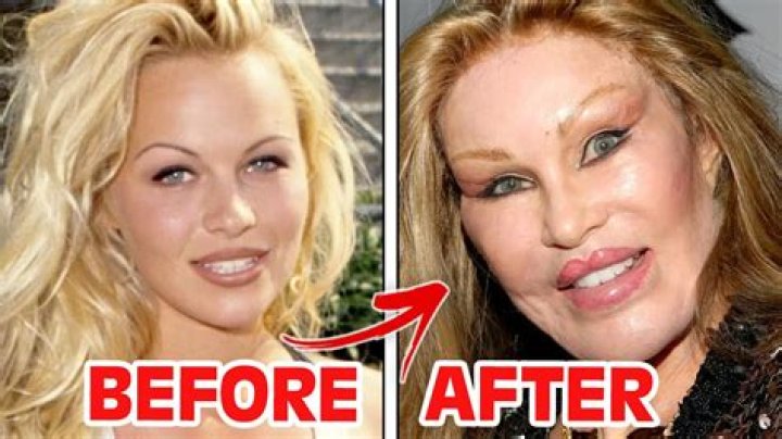 Plastic surgery gone wrong Plastic surgery gone wrong, Celebrity