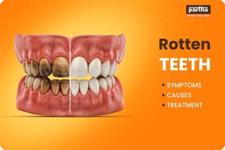 Rotten Teeth Causes, Treatment & Pictures