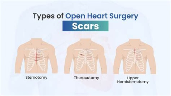 Understanding Open Heart Surgery Scars A Journey Of Healing And Acceptance