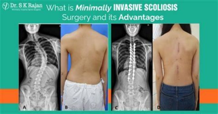 Understanding Scar Scoliosis Surgery Healing Beyond The Curve