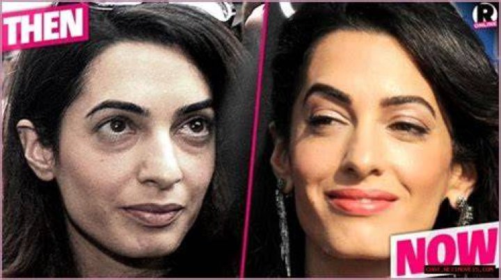 Unveiling the Truth Did Amal Clooney Undergo Plastic Surgery